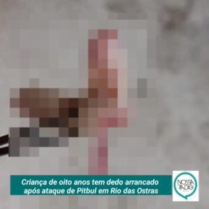 Leia mais sobre o artigo Criança de oito anos tem dedo arrancado  após ataque de Pitbull em Rio das Ostras